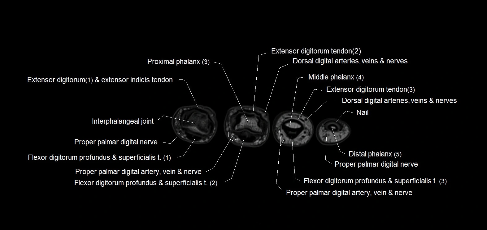 MRI 3T  hand axial labelled cross sectional anatomy imagemy  32.webp